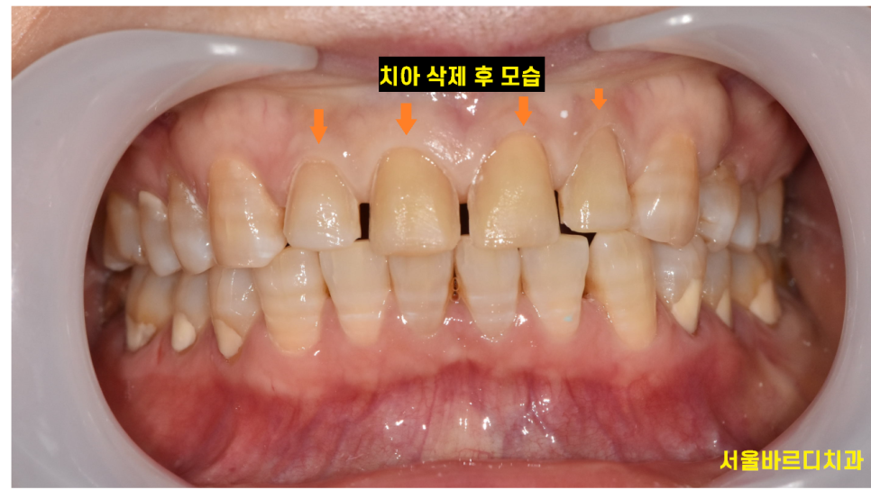 앞니 치아 사이 벌어짐 라미네이트로 컴플렉스 극복! 관련 이미지 4