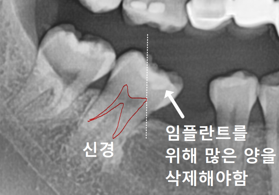 No space for an implant because a tooth has fallen over or a molar has tilted? Read this first. image 4