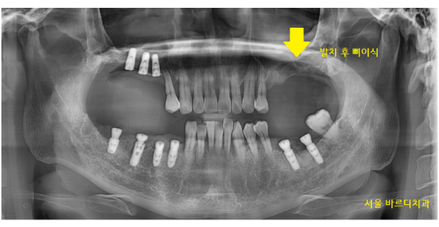 길동 치과 임플란트 뼈이식 후 흡연 상관 있을까? 관련 이미지 8