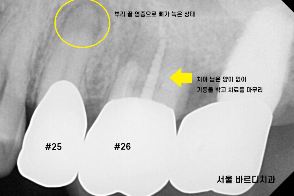 하남 미사 치과 발치 후 당일 임플란트가 가능합니다. 관련 이미지 2