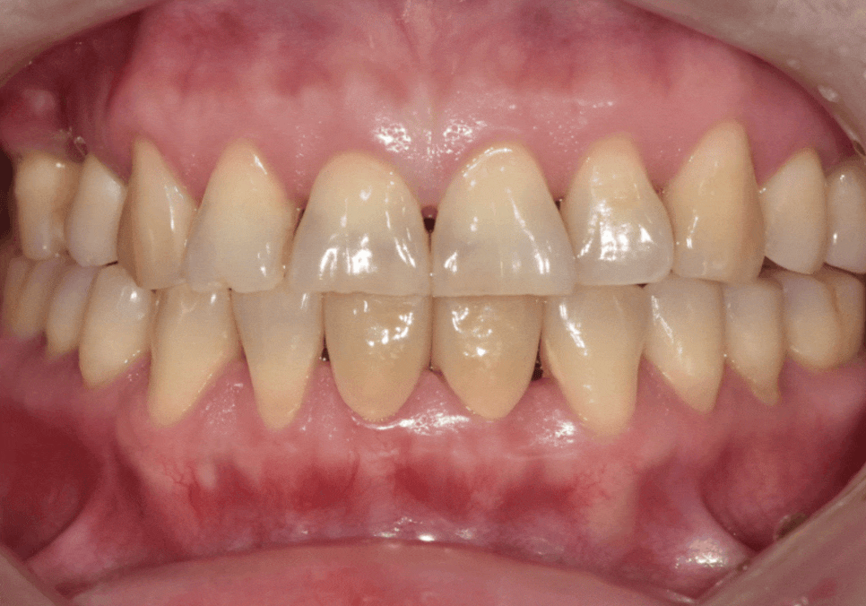 Spaces Between Front Teeth Due to Congenital Missing Teeth: Is Orthodontic Treatment the Only Answer? image 9