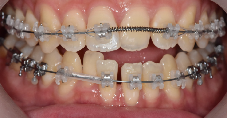 고덕역 교정치과 성인 부정교합 위아래가 거꾸로 물릴때는? 관련 이미지 7