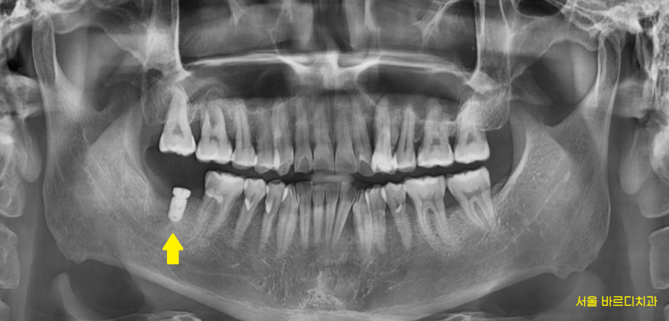 덕풍동 치과 잇몸 욱신 욱신 원인 찾아 임플란트 수술하였습니다. 관련 이미지 8