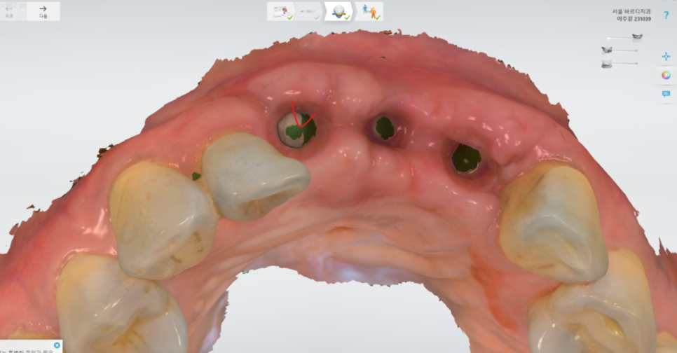 미사 임플란트 보철 새로하고 연결했습니다. 관련 이미지 9