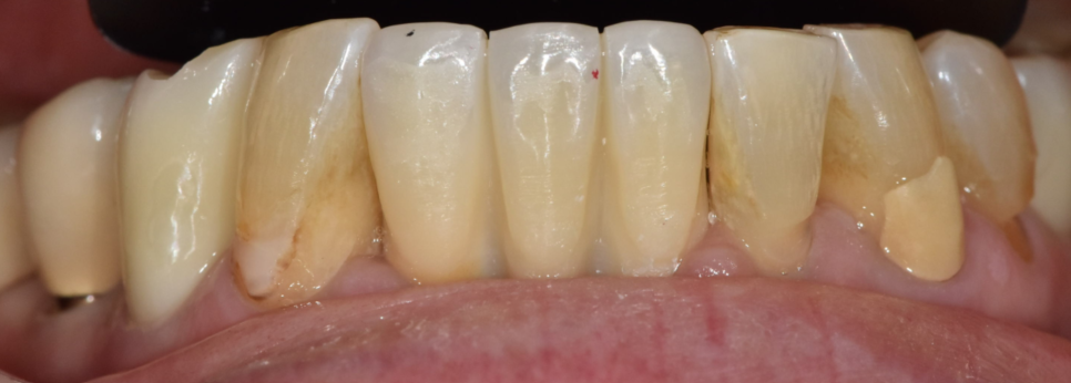 Restored 3 Teeth with Implants After Lower Front Teeth Became Loose and Fell Out image 8