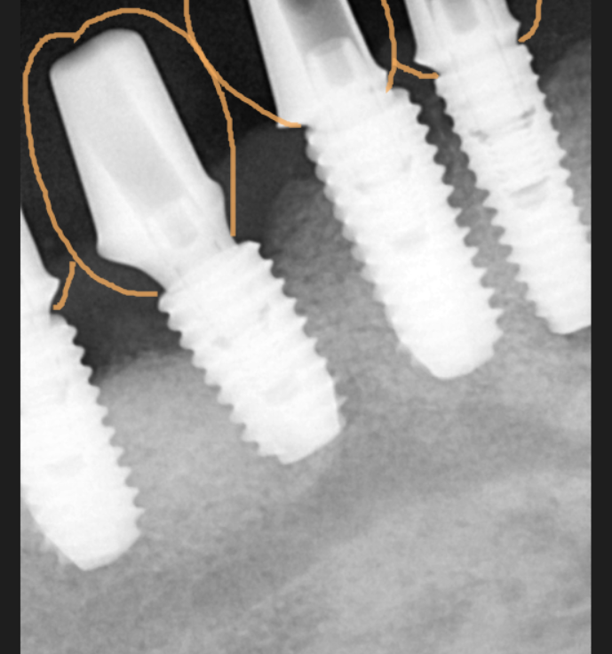 고덕역  치과 틀니쓰다 위아래 전악 임플란트 재건했습니다. 관련 이미지 11