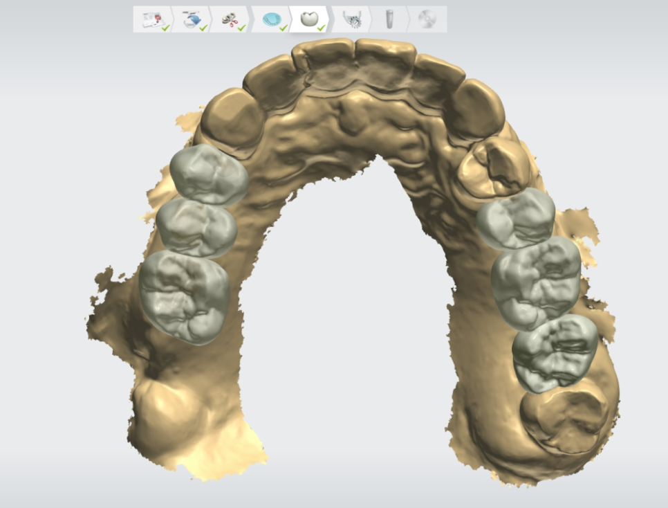 고덕동 치과 뼈이식 동반 양쪽 어금니 임플란트 동시 진행 관련 이미지 8