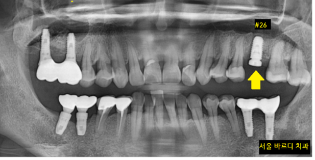 미사역 임플란트 상악동염으로 치아를 발치한 사연 관련 이미지 8