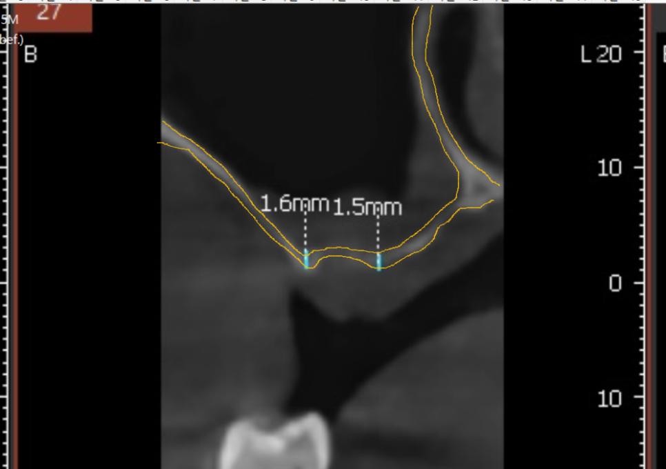 Myeongil-dong Implant Treatment in Your 20s: The Reason It Ended Up Requiring Bone Grafting After Thinking, “I’m Young, So It’ll Be Fine” image 8