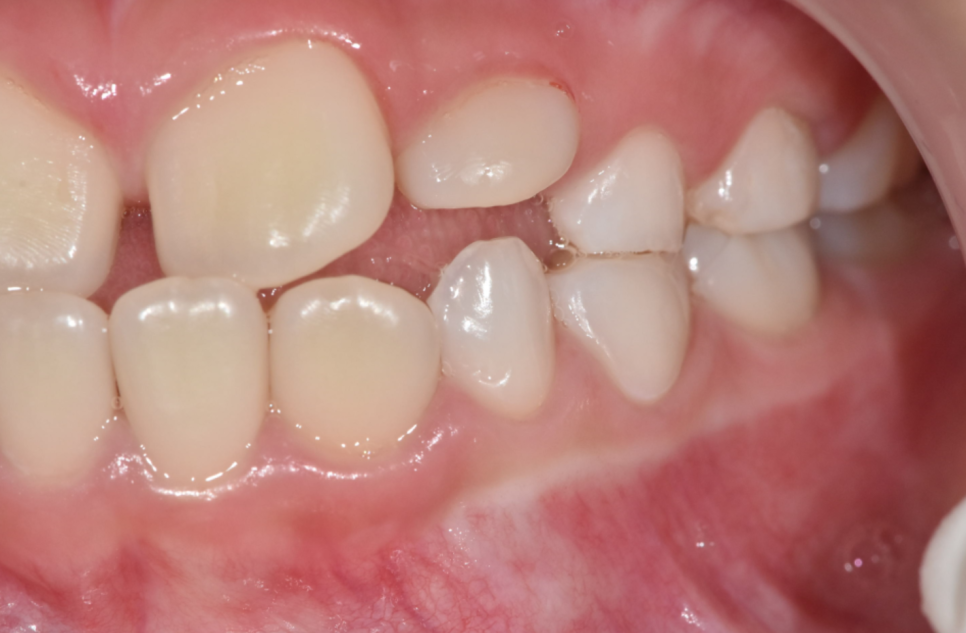 소아 악궁확장 RPE장치란? 성장기 1차 교정 진행해야할 때 관련 이미지 7