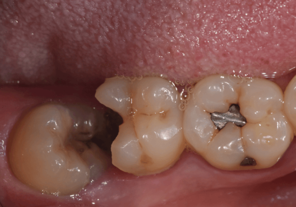 수평 매복 사랑니, 옆으로 누운 사랑니 때문에 멀쩡한 어금니까지 뽑은 사연 관련 이미지 2