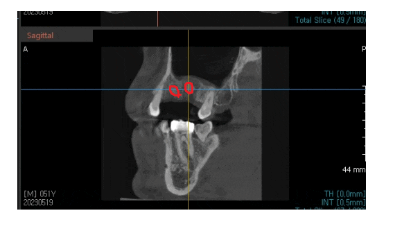 고덕동 치과 잇몸 주저앉음 느낌이 들었다면 늦었을 수도 있습니다. 관련 이미지 1