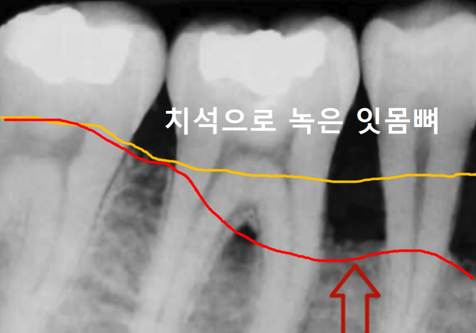 스케일링했더니 잇몸 구멍, 치아 사이 구멍이 생겼어요. 스케일링에 관한 오해 3가지 관련 이미지 8