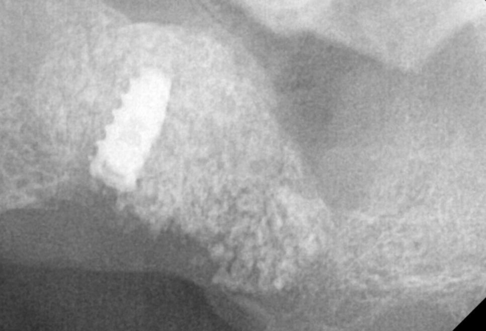 하남시청치과 디지털 임플란트를 고집하는 이유 관련 이미지 6