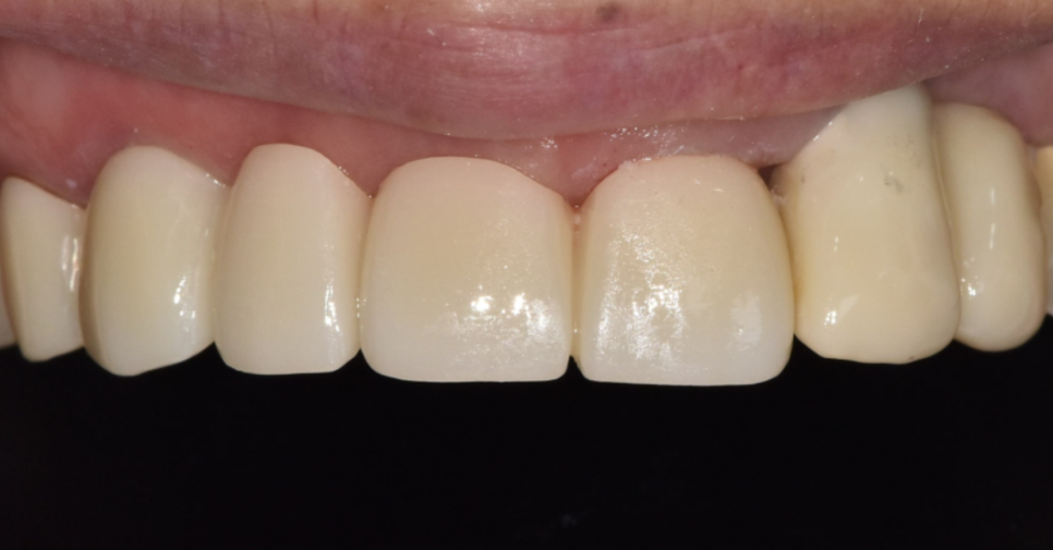 앞니 브릿지 탈락, 씌워둔 게 빠졌어요. 다시 붙일 수 있을까요? 관련 이미지 18