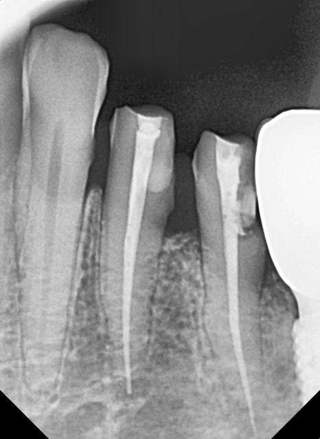 고덕동치과 임플란트 정기검진, 미루다가 수십만 원 손해 봅니다. 관련 이미지 7