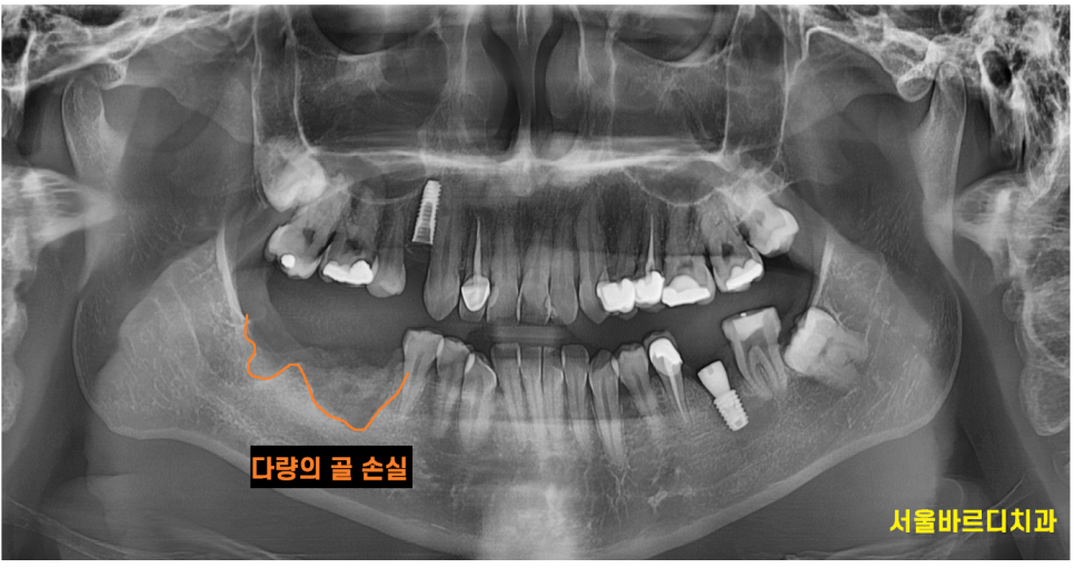 임플란트 시술 성공률, 얼마나 높을까? 처음 하시는 분들께 관련 이미지 2