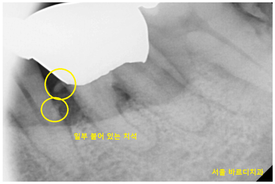 상일동역 스케일링 치과 잇몸치료 받아야하는 이유 필독! 관련 이미지 5