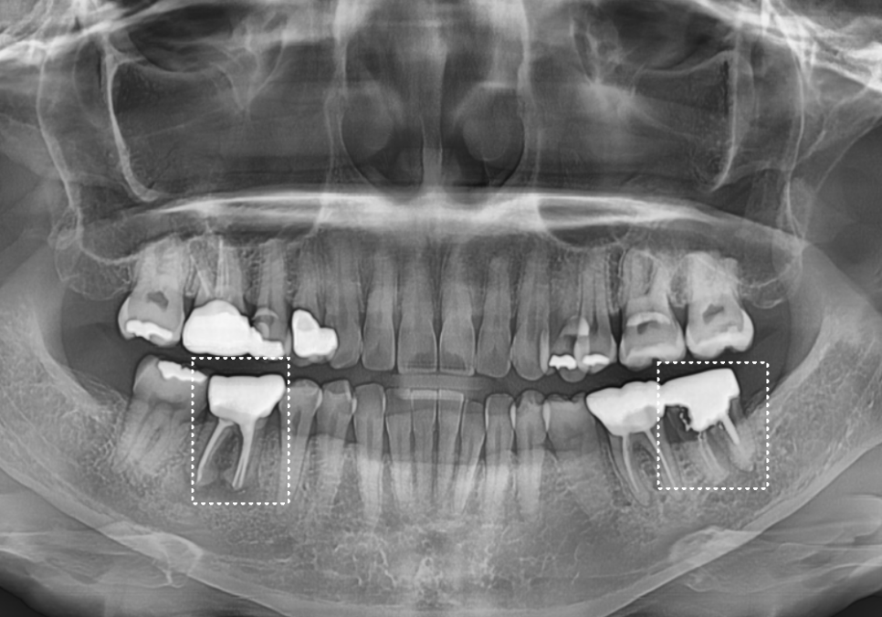 고덕역 임플란트, 뼈이식 꼭 해야 할까? 필수 상황 vs 제외 상황 총정리 관련 이미지 5