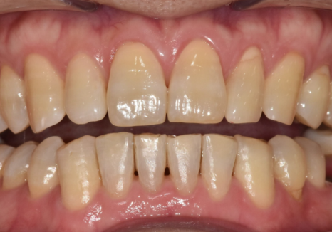 명일역 앞니 부분 교정, 치아 하나만 삐뚤어져 보인다면? 굳이 전체 교정할 필요 없습니다. 관련 이미지 10