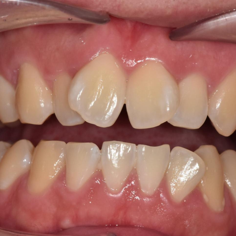 Sangil-dong Orthodontic Dentist: Do Protruding Front Teeth Really Need Orthodontic Treatment? image 6
