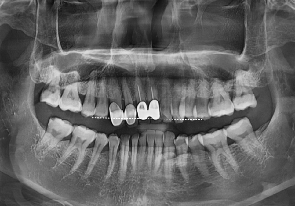 고덕동 심미 보철, 삐뚤어진 앞니, 교정 없이 바로잡은 비결 관련 이미지 1
