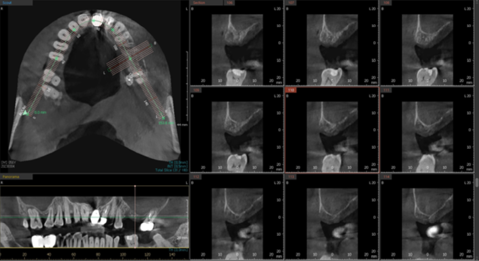 고덕동치과 서울바르디치과 전치부 및 구치부 임플란트 치료증례 #9 관련 이미지 21