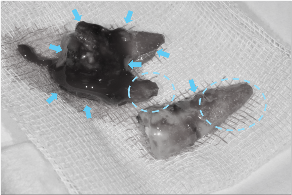 고덕동치과 서울바르디치과 무절개 네비게이션 임플란트 치료증례 #2 관련 이미지 10