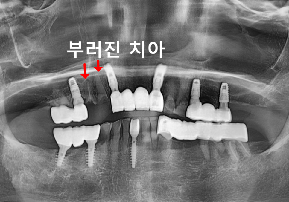 상일동 임플란트 심한 충치로 인한 치아 부러짐 해결한 사례 관련 이미지 7