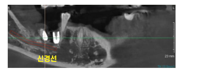 이 흔들림으로 발치 후 뼈이식 진행한 케이스 관련 이미지 10