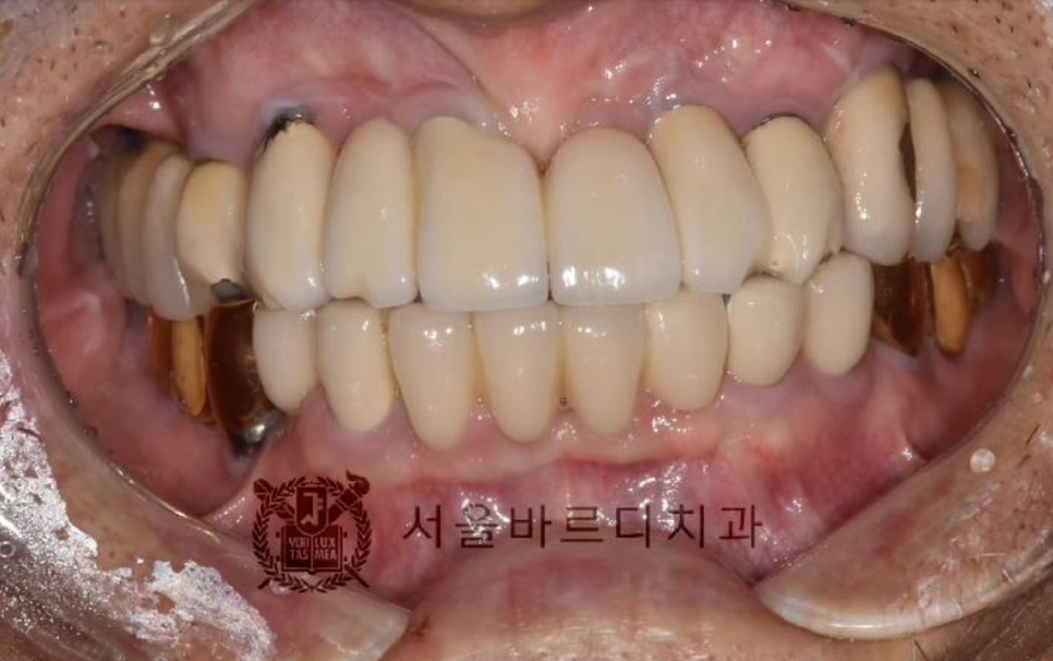 상일동역치과 서울바르디치과 무절개 네비게이션 임플란트 치료증례 #5 관련 이미지 2