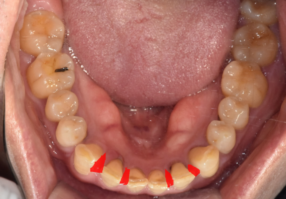 앞니 사이 간격 넓어짐 치아가 벌어져서 보기 싫을 때 크라운 치료 관련 이미지 5