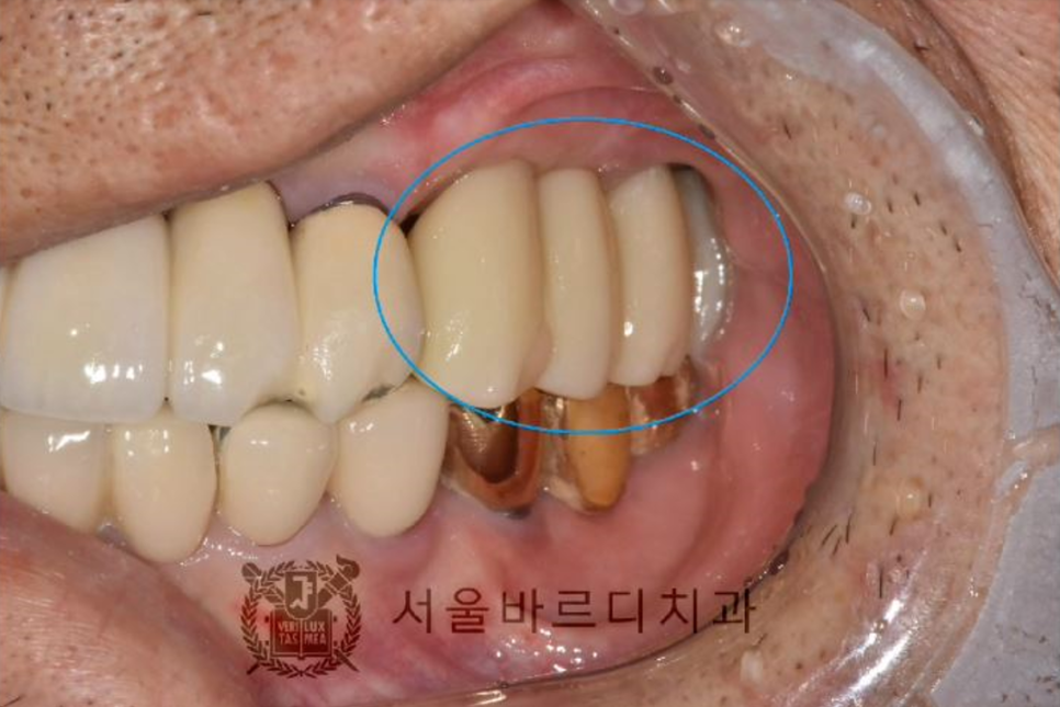 상일동역치과 서울바르디치과 무절개 네비게이션 임플란트 치료증례 #5 관련 이미지 18