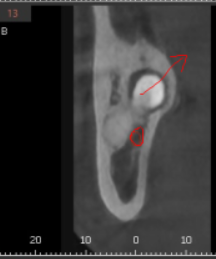 상일동 사랑니 맨날 뽑아야지는 그만!! 매복 치아도 깔끔하게 뽑으세요 관련 이미지 7