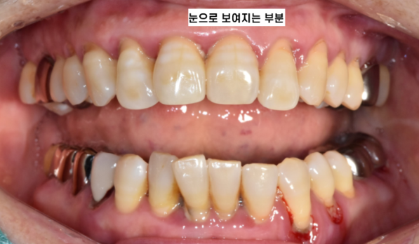 천호동 치과 과잉 진료를 피하는 방법 대공개 관련 이미지 3