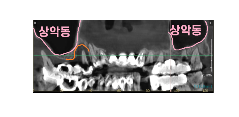 고덕동 치과 뼈이식 동반 양쪽 어금니 임플란트 동시 진행 관련 이미지 3