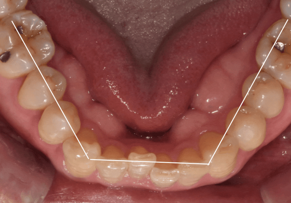 명일역 앞니 부분 교정, 치아 하나만 삐뚤어져 보인다면? 굳이 전체 교정할 필요 없습니다. 관련 이미지 13
