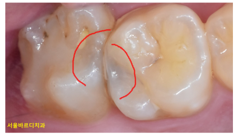 충치치료 후 이시림 자연스러운 반응일까 후유증일까? 관련 이미지 3