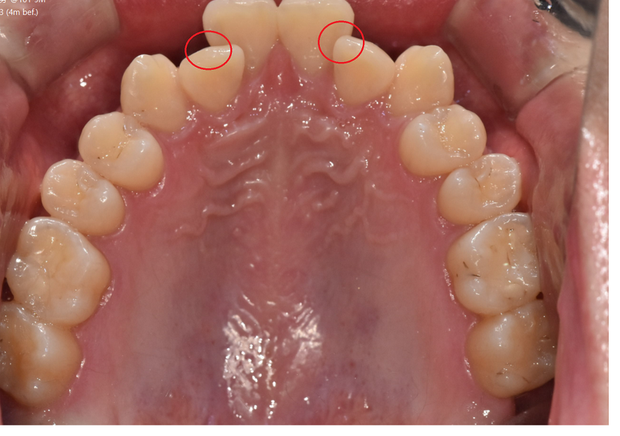 앞니 덧니 때문에 웃기 불편하다면? 상일동에서 치아교정 솔루션 관련 이미지 3