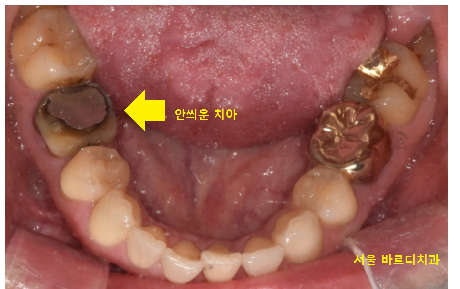 풍산동 치과 임플란트 양쪽 치료 가능한가요? 관련 이미지 4
