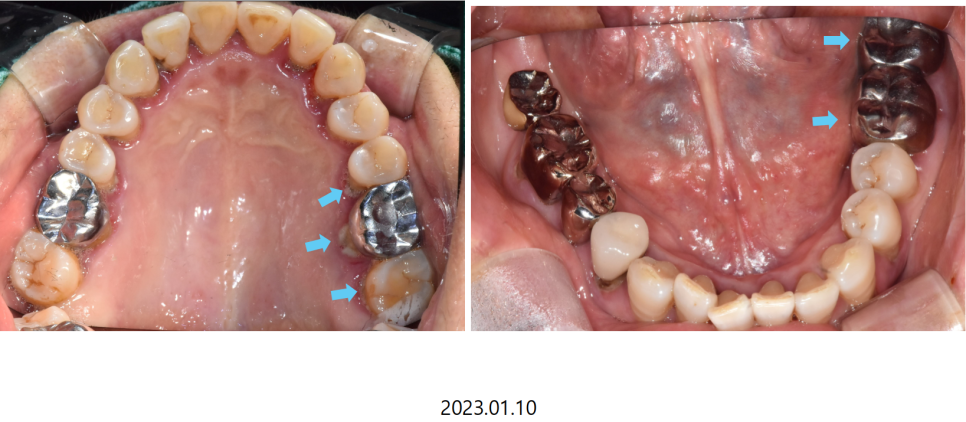 고덕동치과 서울바르디치과 무절개 네비게이션 임플란트 치료증례 #2 관련 이미지 4