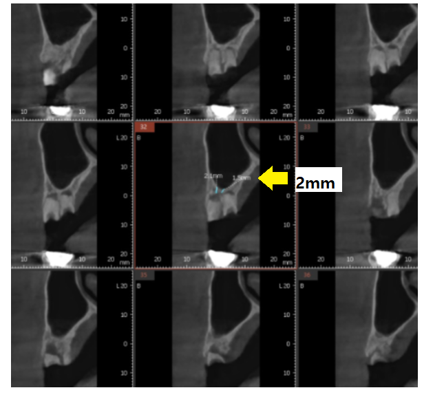 풍산동 치과 임플란트 양쪽 치료 가능한가요? 관련 이미지 9