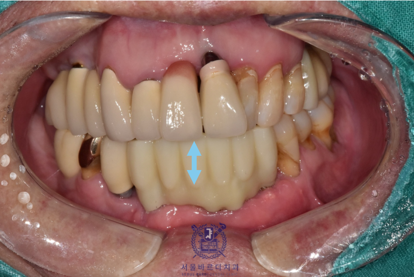 고덕동치과 서울바르디치과 전치부 및 구치부 임플란트 치료증례 #10 관련 이미지 15
