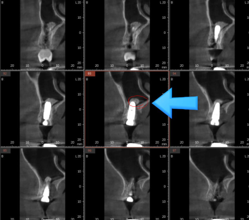 풍산동 치과 임플란트 양쪽 치료 가능한가요? 관련 이미지 12