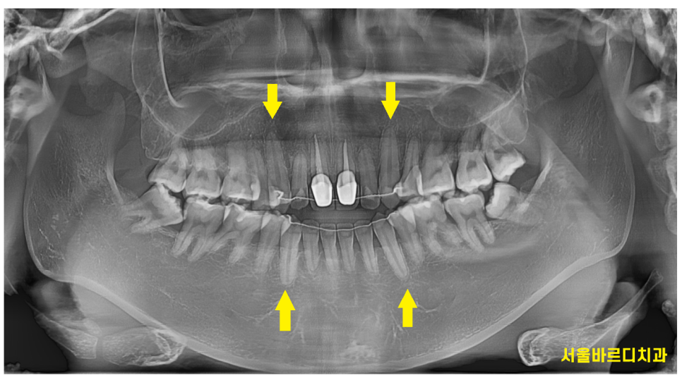치아교정 치아 뿌리 짧아짐 치근 흡수 걱정이에요. 관련 이미지 5