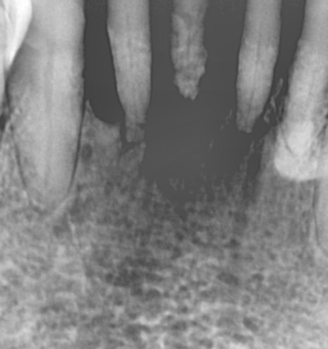 강동구 임플란트 어금니 상실 방치하다 치매까지 옵니다. 관련 이미지 5