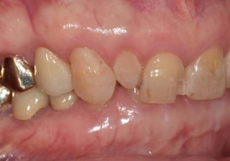 중장년 라미네이트, 70대도 가능한가요? 왜소치와 벌어진 앞니 해결 사례 관련 이미지 9