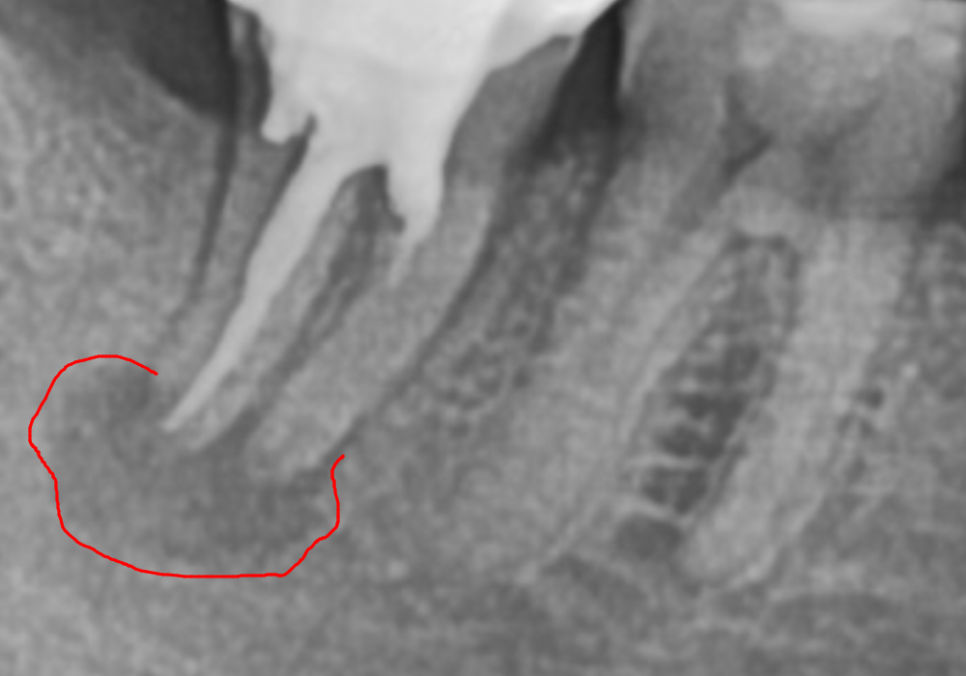 강동구 임플란트 기간, 사람마다 왜 다를까? 즉시식립과 지연식립의 결정적 차이 관련 이미지 5