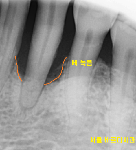 명일동 치과 심미적인 앞니는 하루만에 끝내는 빠른 임플란트로 하세요!! 관련 이미지 4
