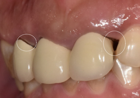 강동구 오래된 보철, 교체 시기는? 아프지 않은데 꼭 바꿔야 하나요? 관련 이미지 4